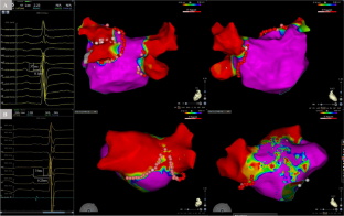 Association between P-wave terminal force in lead V<sub>1</sub> and extent of left atrial low-voltage substrate in older patients with paroxysmal atrial fibrillation.