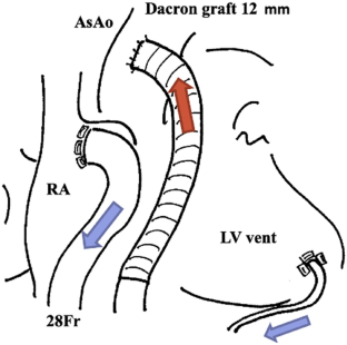 Central extracorporeal membrane oxygenation with left-ventricular vent for fulminant myocarditis: a retrospective study.