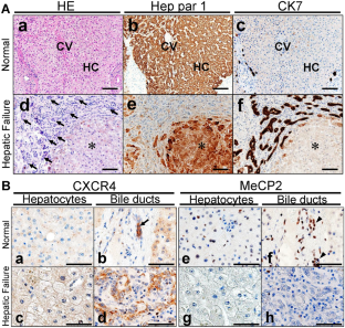 Demethylation in promoter region of severely damaged hepatocytes enhances chemokine receptor CXCR4 gene expression.