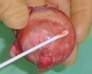 Allogenic bone grafts and postoperative surgical site infection: are positive intraoperative swab cultures predictive for a higher infectious risk?