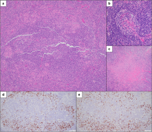 Increased IgG4+ plasma cells are common in excised lymph nodes from children and adolescents without IgG4-related disease