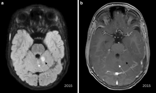 Signal Abnormalities in Noonan Syndrome are Probably Consistent with Focal Areas of Signal Intensity (FASI).