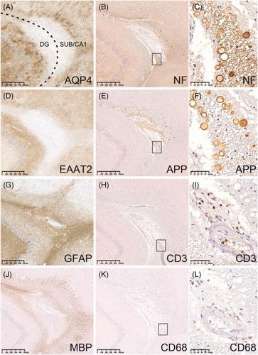 Paths to hippocampal damage in neuromyelitis optica spectrum disorders.