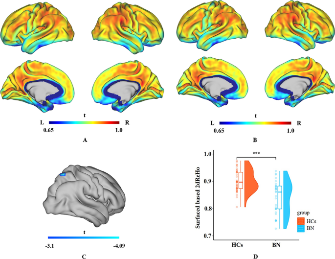 Uncovering neural pathways underlying bulimia nervosa: resting-state neural connectivity disruptions correlate with maladaptive eating behaviors.