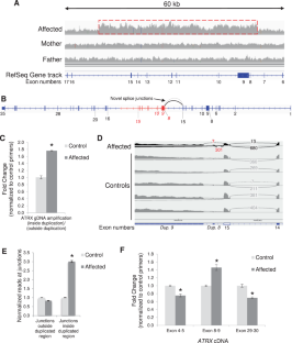 Integrated omics analyses clarifies ATRX copy number variant of uncertain significance