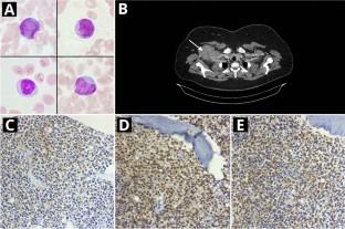 A rare case of embryonal rhabdomyosarcoma with tumor cells in peripheral blood mimicking acute leukemia.