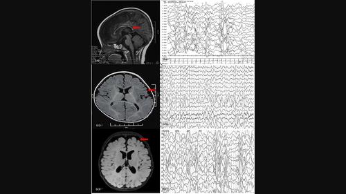 Infantile epileptic spasm syndrome as a new NR2F1 gene phenotype