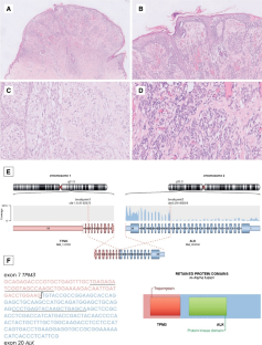 Novel gene fusion discovery in Spitz tumours and its relevance in diagnostics.