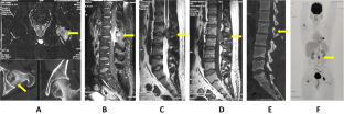 Spinal Rosai-Dorfman disease-a report of 2 cases and review of literature.