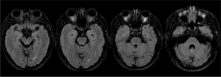 Amyotrophic Lateral Sclerosis with SOD1 Mutation Presenting with Progressive Cerebellar Ataxia.