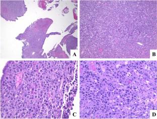 Anaplastic large cell lymphoma presenting as a mass in the uterine cervix: a case report