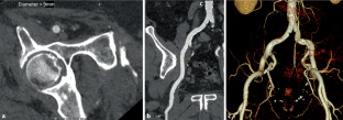 Computed tomography to guide transcatheter aortic valve implantation.