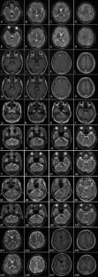 Pembrolizumab for the treatment of progressive multifocal leukoencephalopathy in China.