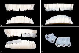 Comparison of enamel demineralization and periodontal status between direct and digital indirect bonding techniques : A split-mouth clinical trial of direct vs. digital indirect bonding.