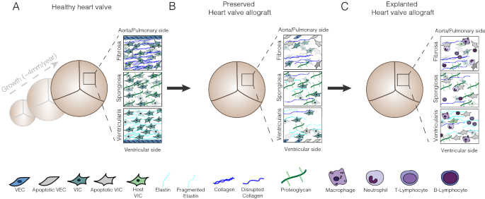 Preservation of human heart valves for replacement in children with heart valve disease: past, present and future.