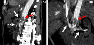 Aortic thrombosis with visceral malperfusion during circulatory support with a combination of Impella and extracorporeal membrane oxygenation for postcardiotomy cardiogenic shock.