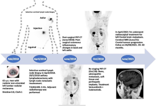 Selective sentinel lymph node biopsy as a prognostic method in cutaneous malignant melanoma: a decade of experience