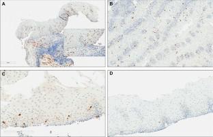 Mast Cell Esophagitis: A Novel Entity in Patients with Unexplained Esophageal Symptoms.