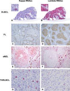 Immunoglobulin light chain transcript detection by ultrasensitive RNA in situ hybridization for B-cell lymphoma diagnosis.