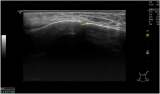 Evaluation of the validity of mental foramen USG measurements by comparison with CBCT and determination of blood flow.