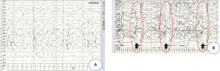 Clinical and functional study of two de novo variations of CDKL5 gene.