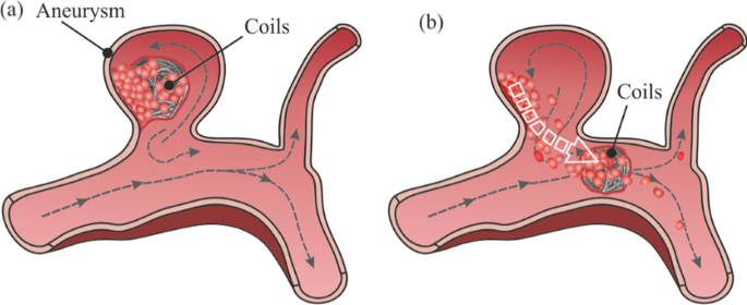 Numerical Study of a Thrombus Migration Risk in Aneurysm After Coil Embolization in Patient Cases: FSI Modelling.