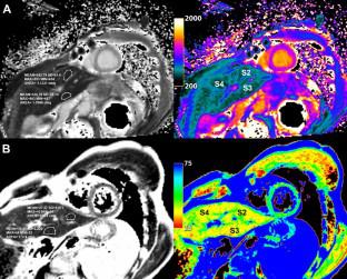 Liver T1 and T2 mapping in a large cohort of healthy subjects: normal ranges and correlation with age and sex.