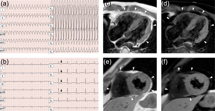 Arrhythmogenic right ventricular cardiomyopathy in a Japanese patient with a homozygous founder variant of DSG2 in the East Asian population.