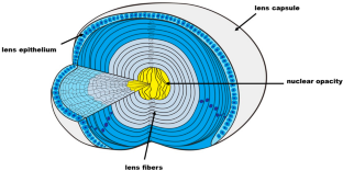 Antioxidant System and Endoplasmic Reticulum Stress in Cataracts.