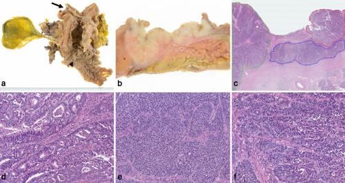 Mixed adenoneuroendocrine carcinoma of the non-ampullary duodenum with mismatch repair deficiency: a rare case report