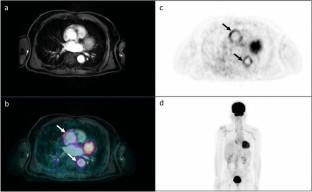 Hybrid PET/MRI imaging in non-ischemic cardiovascular disease