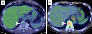 Prognostic value of <sup>18</sup>F-fluorodeoxyglucose uptake in the bone marrow on pretreatment positron emission tomography/computed tomography in patients with esophageal cancer who underwent esophagectomy.