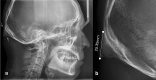 Enlarged occipital spur and craniofacial morphology: a cephalometric analysis.