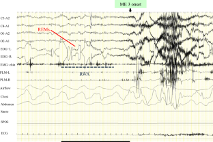 Video polysomnographic analysis of elevated EMG activity and rapid eye movements before abnormal behaviors in REM sleep behavior disorder.