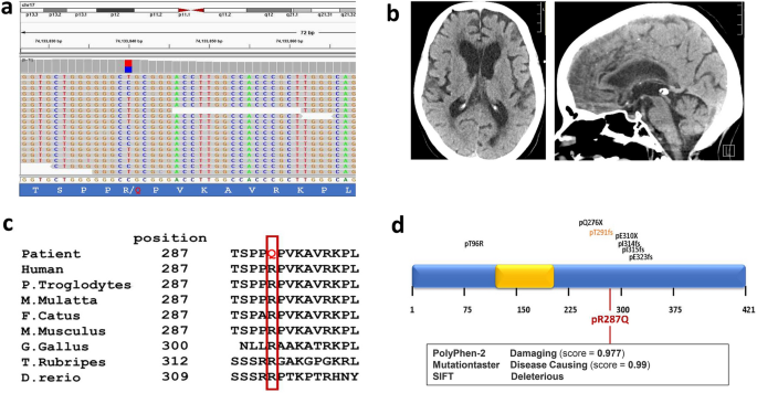 Heterozygous FOXJ1 Mutations Cause Incomplete Ependymal Cell Differentiation and Communicating Hydrocephalus.