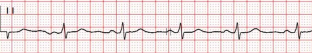 The effect of high-power short-duration pulmonary vein isolation on PWPT-a predictor of paroxysmal atrial fibrillation.