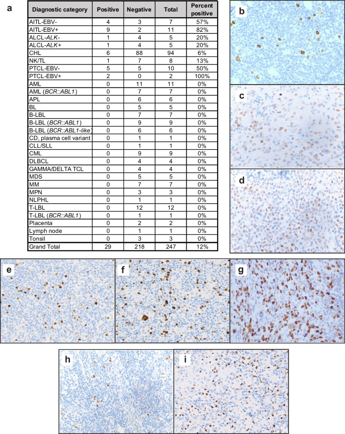 SATB2 expression in hematolymphoid neoplasms.