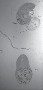 A Case of Detection of Trematode Metacercaria Pygidiopsis Looss, 1907 in the Mollusc Hydrobia acuta (Draparnaud, 1805) in the Black Sea