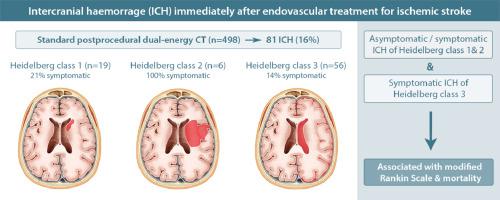 Prognostic implications of intracranial haemorrhage on dual-energy CT immediately following endovascular treatment for acute ischemic stroke