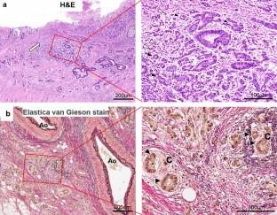 Immunohistochemical analysis of the distribution of RANKL: a case of disseminated carcinomatosis of bone marrow as the first presentation of relapse in curatively resected colorectal cancer.