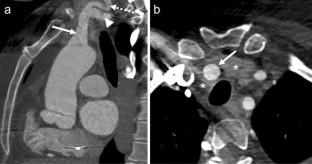 The combined intrathyroidal course of the brachiocephalic artery, right common carotid artery and right subclavian artery.