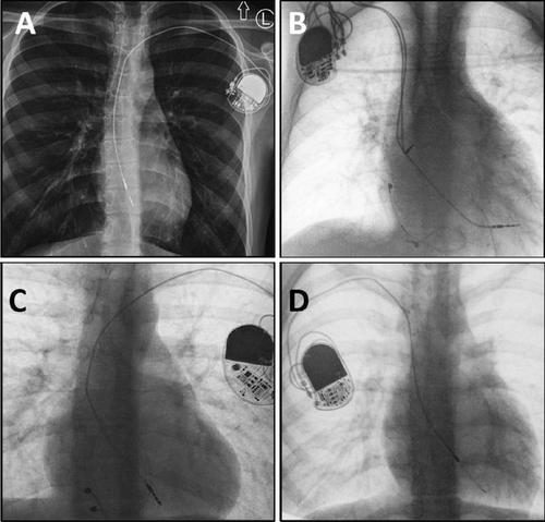 Lead Extraction in Children and Young Adults: When is the Best Time for Lead/System Replacement?