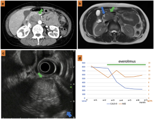 Mucinous Amphicrine Carcinoma of the Pancreas: A Diagnostic Pitfall.