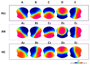 EEG Spatial-temporal Dynamics of Resting-state Activity in Young Women with Anorexia Nervosa: Preliminary Evidence.