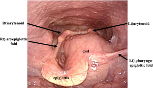 Huge laryngeal saccular cyst causing obstructive sleep apnea.