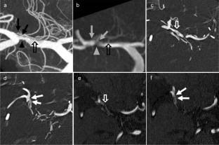 Anatomical information of the lenticulostriate arteries on high-resolution 3D-TOF MRA at 3 T: comparison with 3D-DSA.