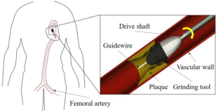 Performance of novel 3D printing tools in removing coronary-artery calcification tissue