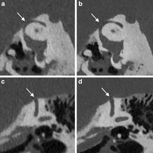 Photon Counting Versus Energy-integrated Detector CT in Detection of Superior Semicircular Canal Dehiscence.