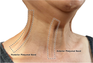 Sonoanatomy of the platysmal bands: What causes the platysmal band?