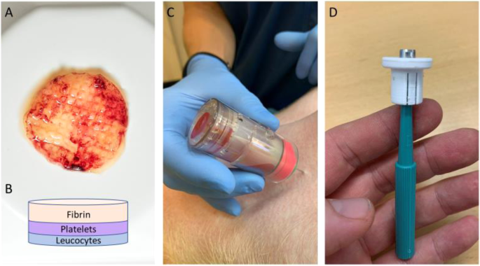 An autologous blood-derived patch as a hemostatic agent: evidence from thromboelastography experiments and a porcine liver punch biopsy model